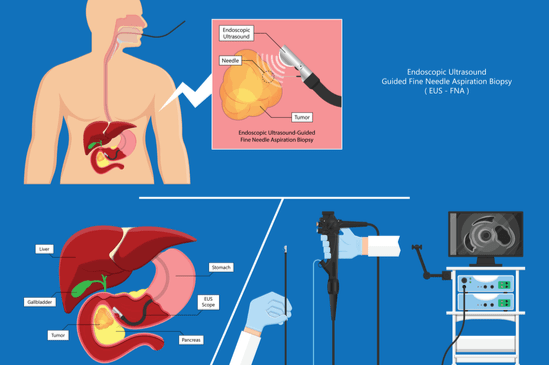 Endoscopic Ultrasonography visual chart procedure
