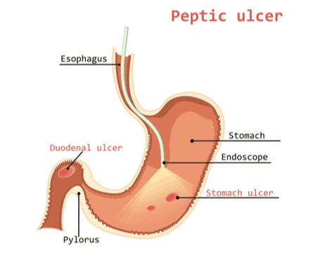 Peptic ulcer medical visual diagram chart