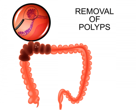 colonoscopy chart with polyps visual diagram